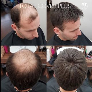 Total Cover Plus Hair System Manchester