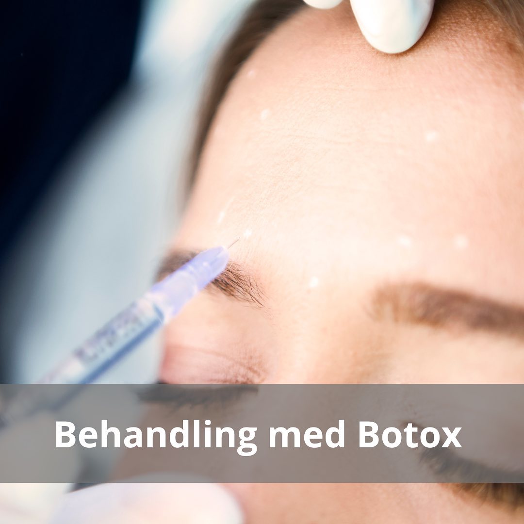 Botox behandling er en af de mest populære behandlinger, inden for kosmetiske...