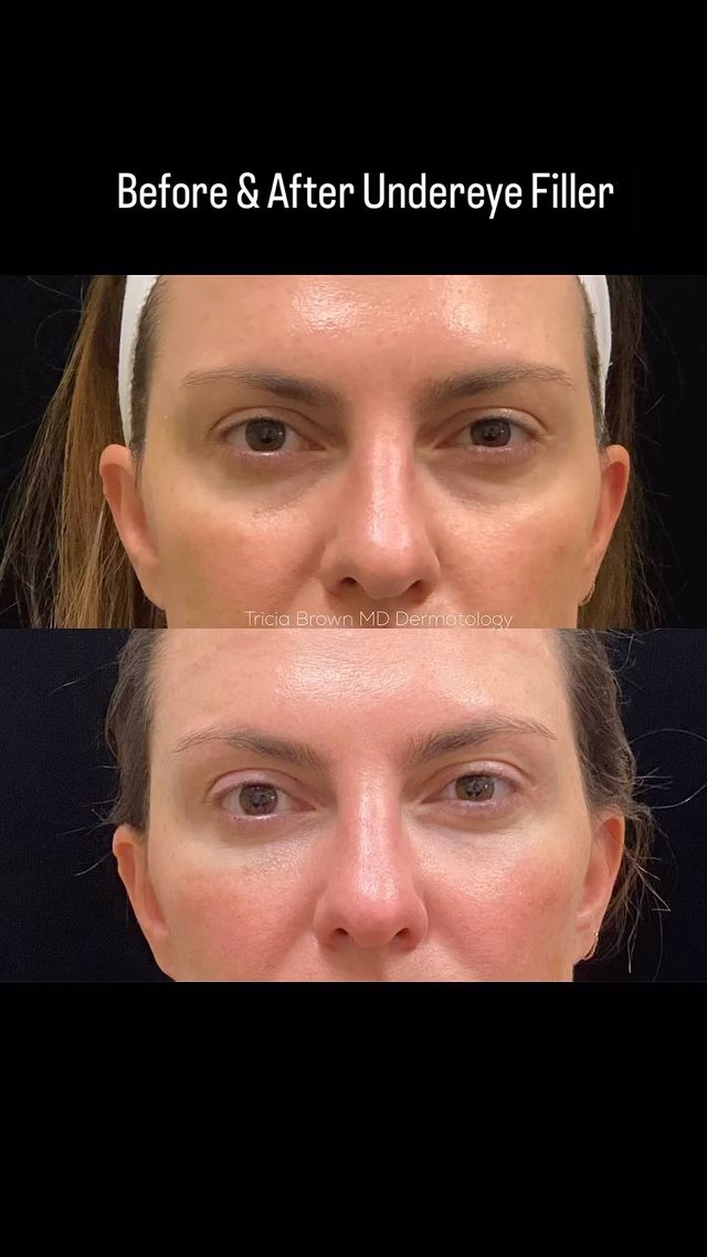 HELLO!👋
All she needed was a little under eye filler to perk her right up. ...