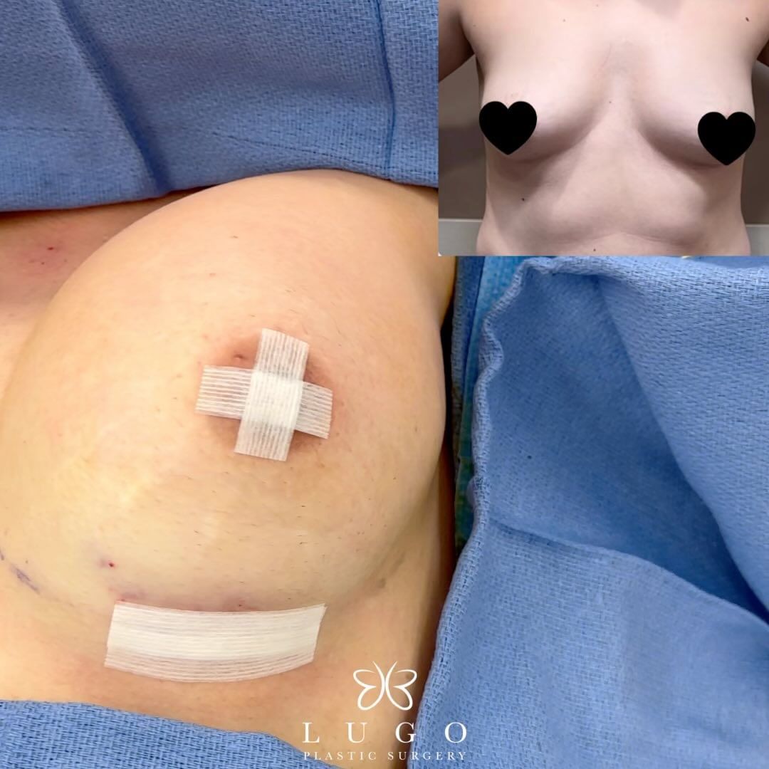 Check out this beautiful #breastaugmentation with silicone implants #sientrai...