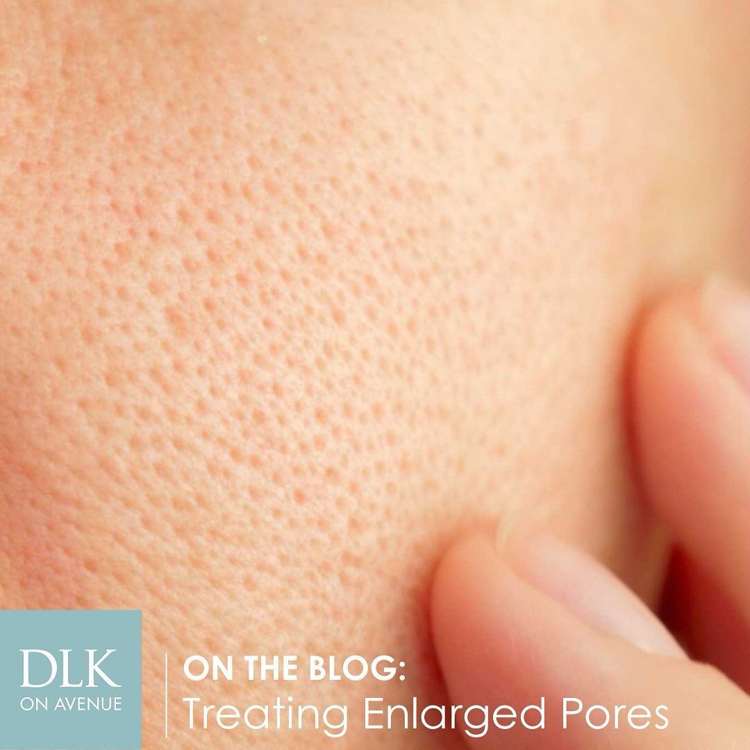 Do you suffer from large, visible pores that make your skin appear bumpy and ...