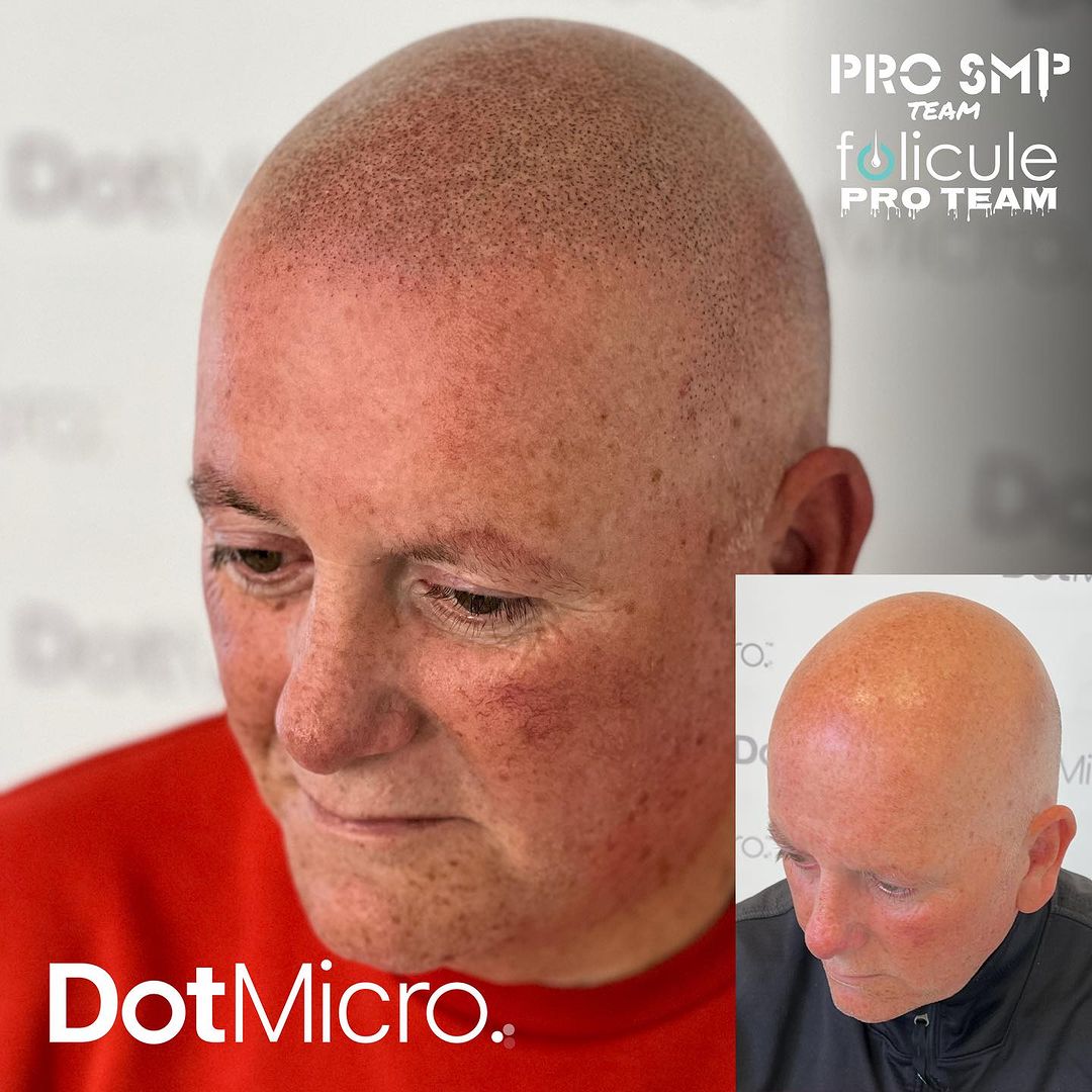 Tailored Micro Ink - Pro SMP Treatment