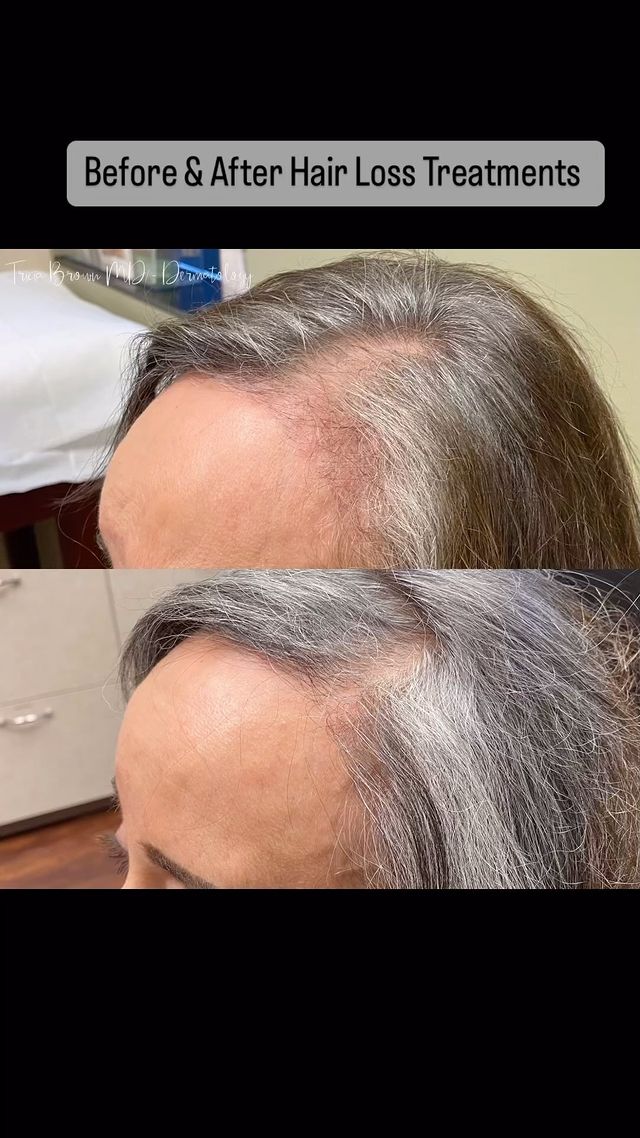 Patience is key...especially with hair.👍🏼
Hair loss treatments have come ...